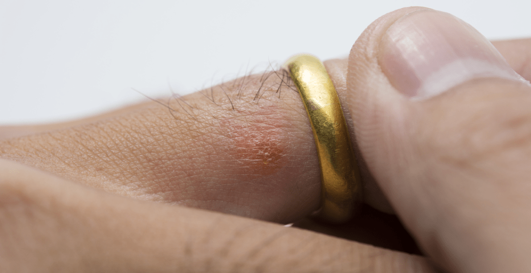 Tips Mengatasi Alergi Logam